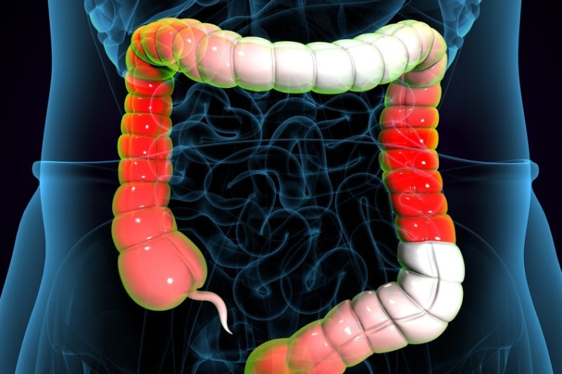 Ulcerative Colitis Treatment and Digestive Health