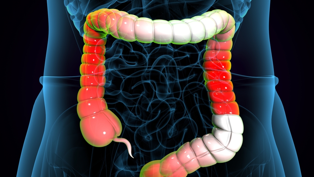 Ulcerative Colitis Treatment and Digestive Health