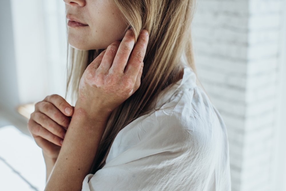 psoriasis